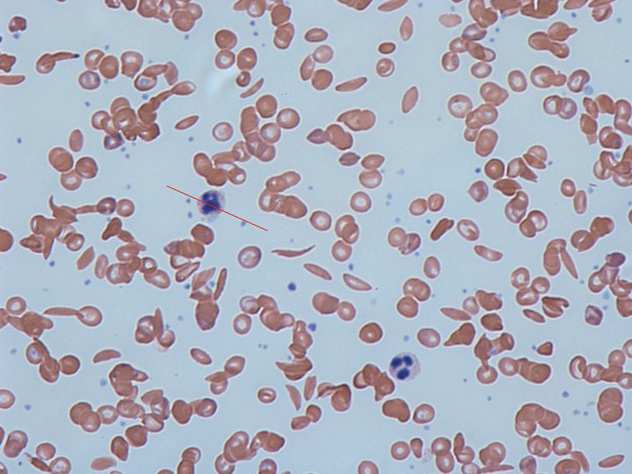micrograph showing both healthy round red blood cells and sickle-shaped cells