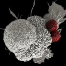 This electron micrograph shows an oral squamous cancer cell being attacked by two cytotoxic T cells.