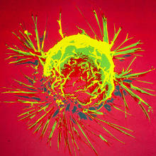 Electron micrograph of a single cell of breast cancer