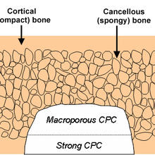 Schematic of cortical and cancellous bone, showing a cavity partially filled with a macroporous CPC paste, followed by a strong CPC paste.