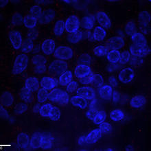 samples of breast cancer cells from a patient with normal HER2 expression