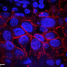 amples of breast cancer cells from a patient with over production