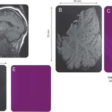 Distribution Map of gadolinium deposition within the cerebellum - Neurology, 88 (12) 1206-1208, 2017