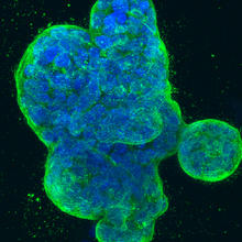 Three-dimensional culture of human breast cancer cells, with DNA stained blue and a protein in the cell surface membrane stained green.
