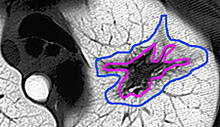 Example of tumor boundary detection