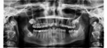 x-ray showing teeth