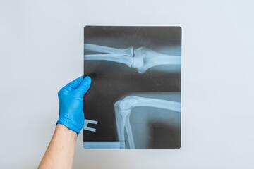 A person wearing a blue medical glove holds up an X-ray film of a bone joint. 