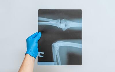 A person wearing a blue medical glove holds up an X-ray film of a bone joint. 