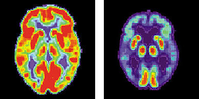 PET scans