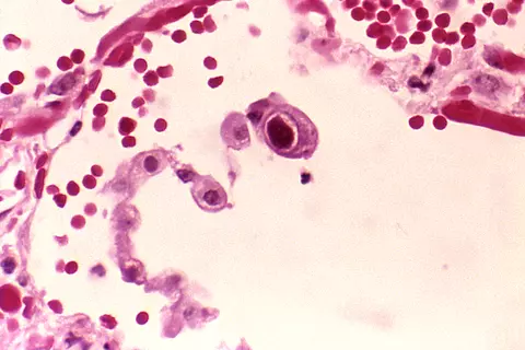 Photomicrograph showing human lung cells infected with cytomegalovirus. 