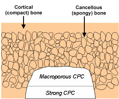 Schematic of cortical and cancellous bone, showing a cavity partially filled with a macroporous CPC paste, followed by a strong CPC paste.