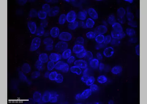 samples of breast cancer cells from a patient with normal HER2 expression