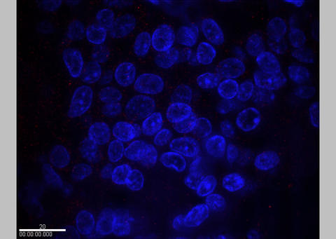 samples of breast cancer cells from a patient with normal HER2 expression