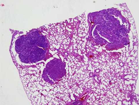 Section of lung tissue from a double knockout mouse, stained to show lung tumors. 
