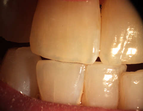 Closeup of a person's teeth shows faint vertical cracks.