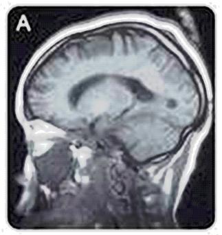 Series of MRI images labeled A to E showing different views of brain tissue, some with gadolinium highlighted in blue against a purple background. 