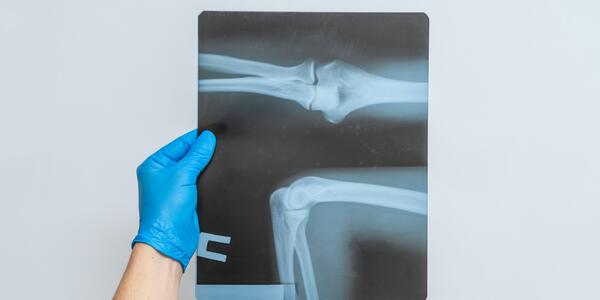 A person wearing a blue medical glove holds up an X-ray film of a bone joint. 