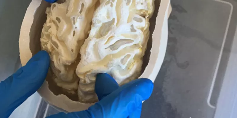 white matter mimic in the bottom half of the artificial cranium