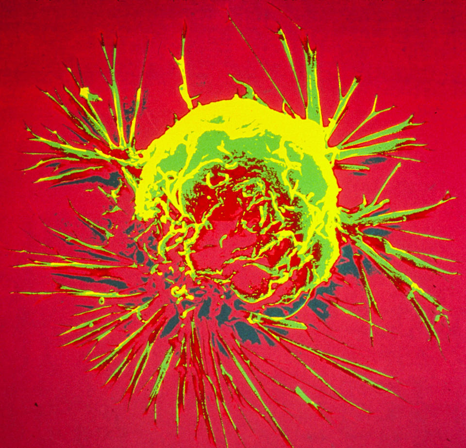 Electron micrograph of a single cell of breast cancer