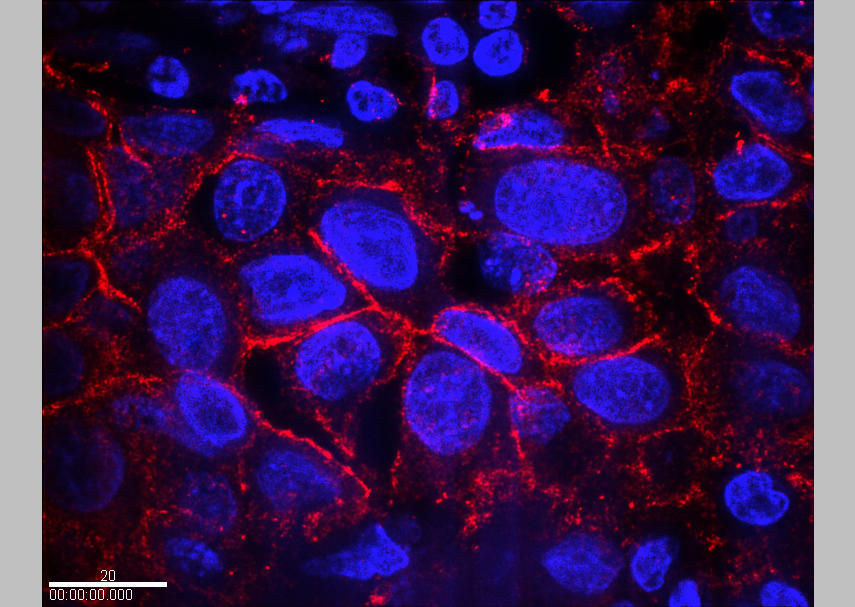 amples of breast cancer cells from a patient with over production