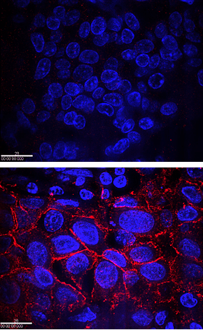 IHC image of HER2 cancer