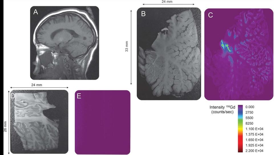 Distribution Map of gadolinium deposition within the cerebellum - Neurology, 88 (12) 1206-1208, 2017