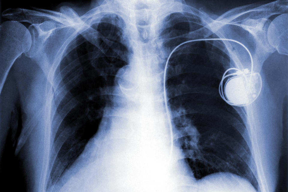 Pacemaker x-ray image
