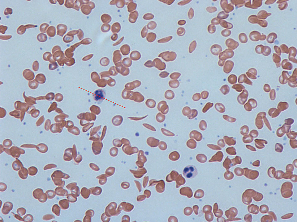 micrograph showing both healthy round red blood cells and sickle-shaped cells