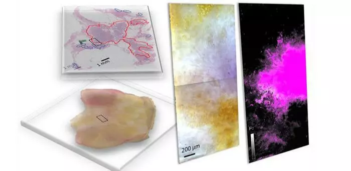 Freshly dissected tissue (lower left) and its pathology-prepared slide with identified tumor regions by a pathologist (upper left), and a pseudo-color image of hyperspectral dark-field microscopy (HSDFM) data cube (middle) region marked on the tissue images on the left.
