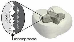 Illustration of a tooth with filling material including an enlargement showing the interphase region between the tooth and composite material.