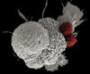 This electron micrograph shows an oral squamous cancer cell being attacked by two cytotoxic T cells.